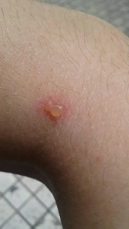 什么感觉都没有,第二天就起一个水泡 昨天夜里睡不着,就有一只虫子爬