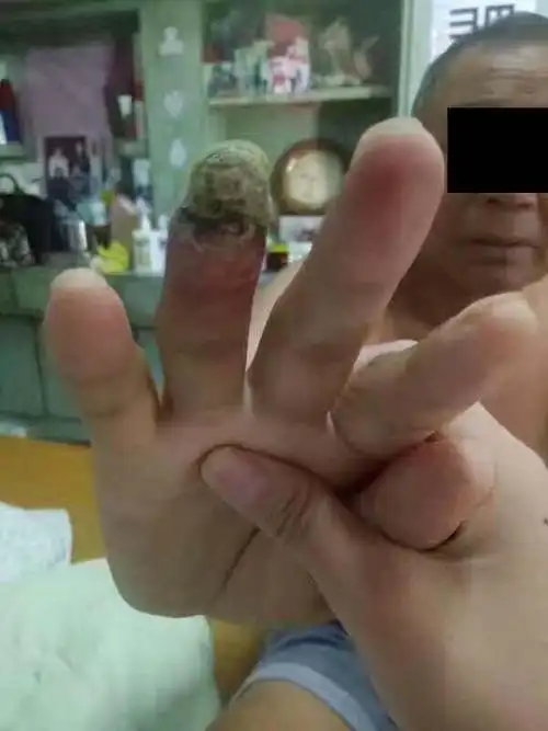 糖尿病引起的手脚丫烂用什么药抹效果最好