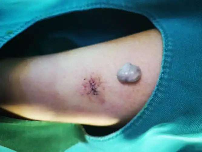 粉瘤手术后疤痕图片,粉瘤手术疤痕图片15天-图片大观-奇异网