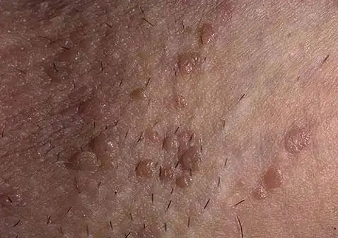 阴囊上有小肉粒可能是尖锐湿疣,其次为生殖器疱疹,毛囊炎,皮脂腺囊肿