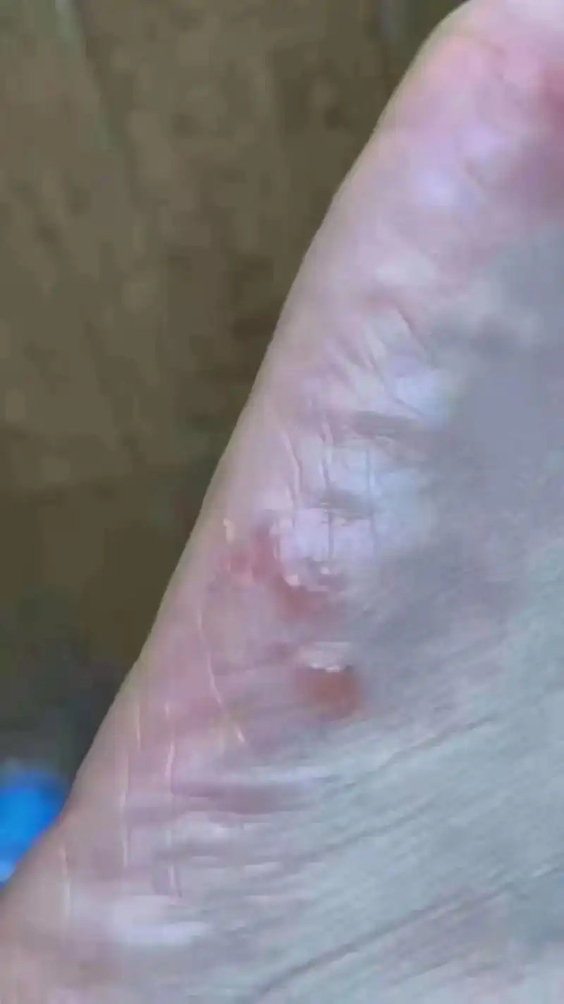 水泡型脚气: 特别痒,挠破了水流到哪里水泡长到哪里.是真菌最 - 抖音