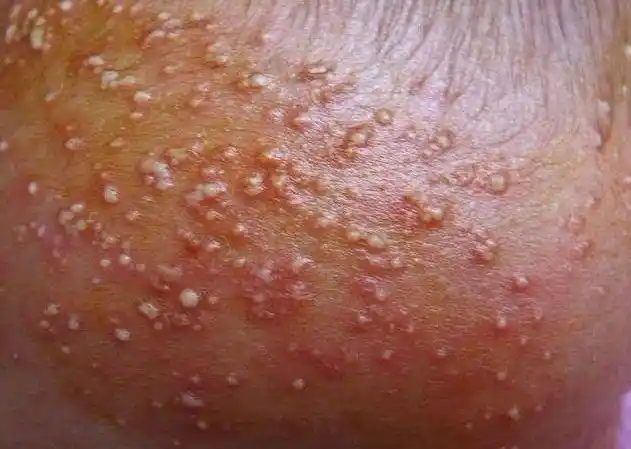 婴儿热痱子症状图片_痱_北京京城皮肤病医院(北京医保定点机构)