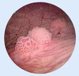 膀胱里发现一朵"小花",竟然是癌?