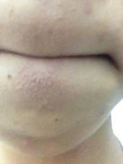 下巴那一片像粉刺的是什么呀,我15岁该咋弄没