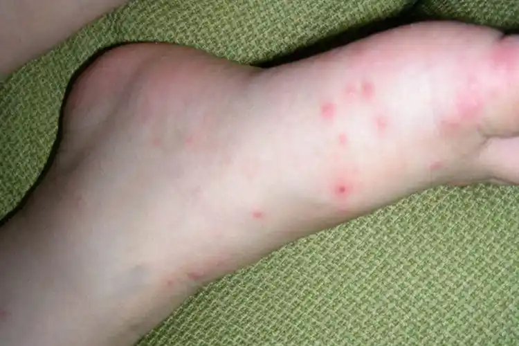 四岁小孩手足口病足部症状图