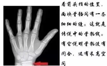 了解一下骨骺线一旦闭合基本上没有长高空间了