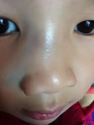 医生我女儿被小朋友从床上拉倒了,摔了脸,现在鼻子一边肿起来,请问