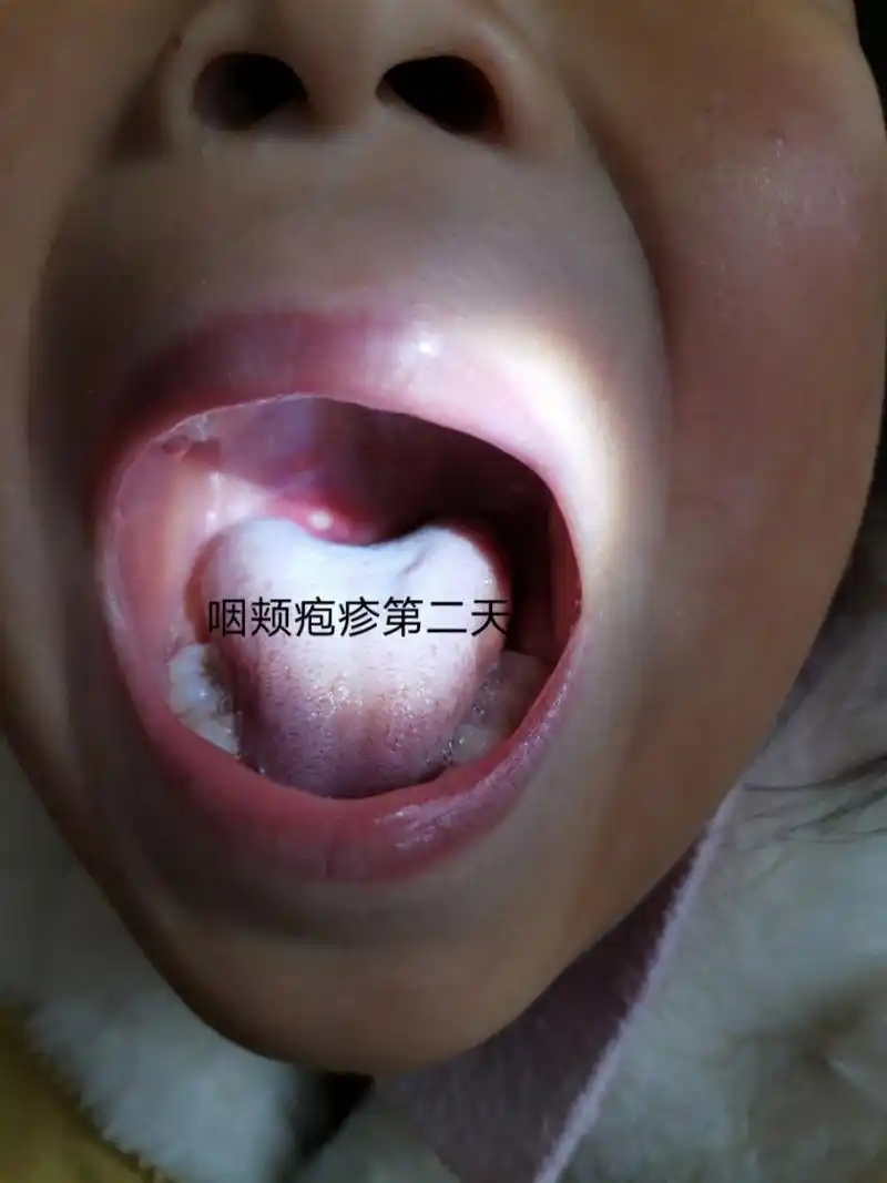 儿童疱疹性咽颊炎三天就好 儿童疱疹性咽颊炎简称咽颊疱疹,主要是由于