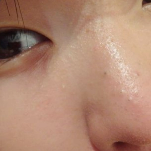 鼻子上的黑头图片放大