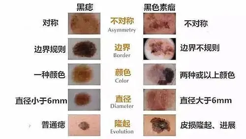 【健康】有"痣"青年看这里,教你区分黑痣和黑色素瘤_介绍_症状表现