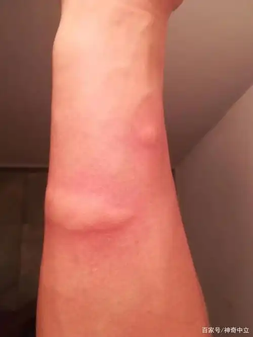 斯里兰卡回国后遗症 c02