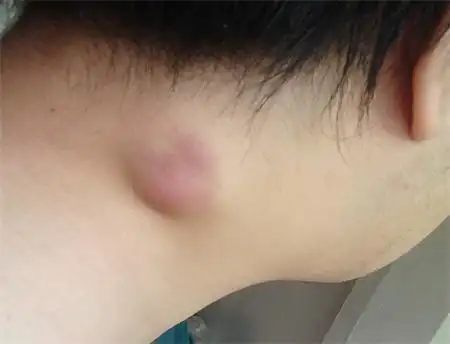 腋下淋巴结肿大的危害