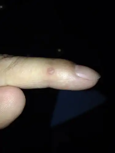 这是不是刺瘊该怎么治疗