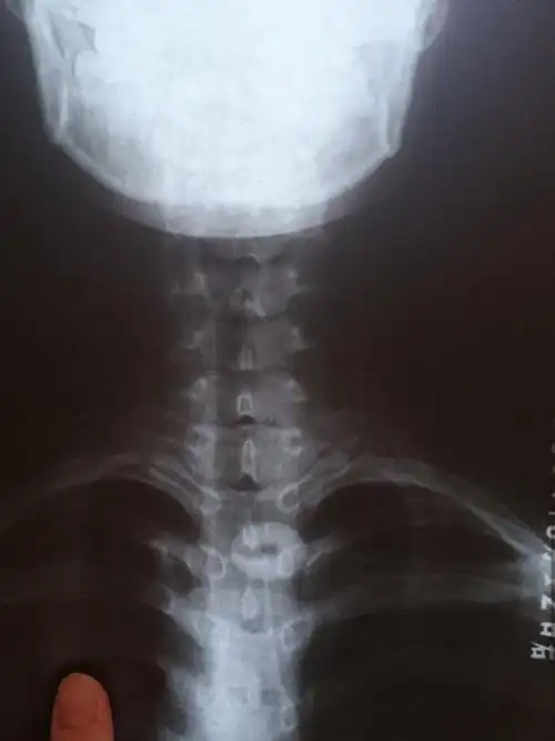 24岁颈椎骨质增生