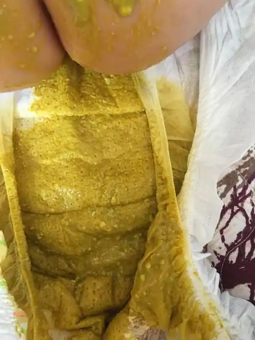 宝宝这样的大便正常吗?(有图慎入)