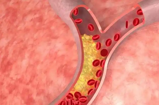 女子查出高血脂,到突发脑梗不到半年,医生:1类零嘴吃太多了