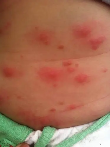 这是不是荨麻疹