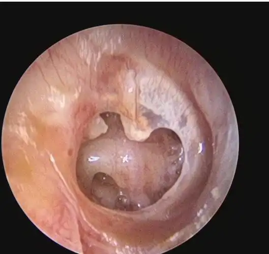 鼓膜穿孔 - 好大夫在线