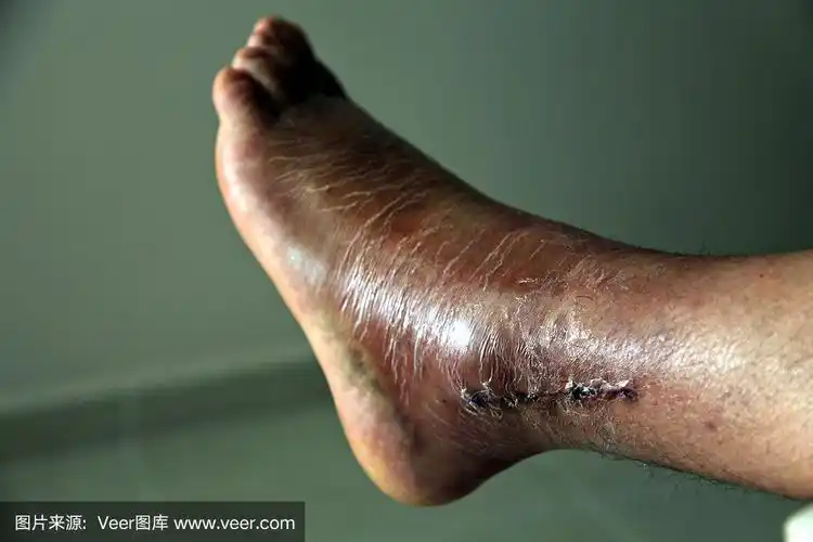 断腿手术,取下石膏