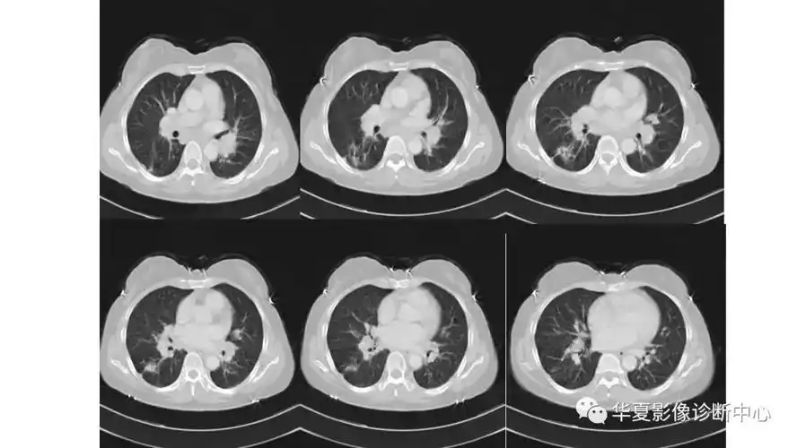 病例肺结节病1例ct影像表现