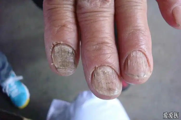 看图诊断36……甲营养不良