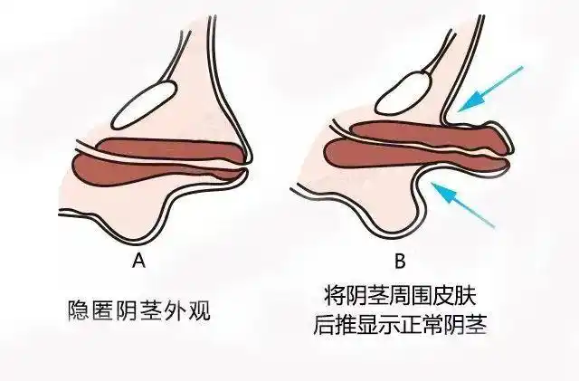 家长注意男孩鸡鸡短小不要错过最佳治疗时机