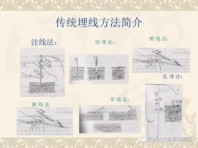 【医生必备】埋线操作规范