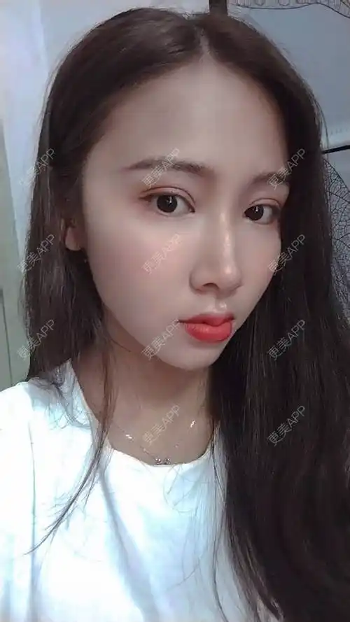 全切双眼皮效果图_素人渔夫yy全切双眼皮效果图_术后53天__更美