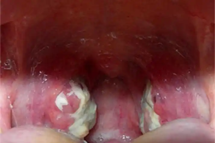 扁桃体角化症症状图片