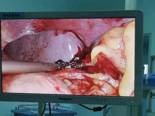 术中发现脾脏中部长约5cm破口,并可见活动性出血.