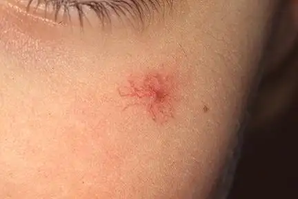 红痣图片(人人身上都长的) - 赤虎壹号