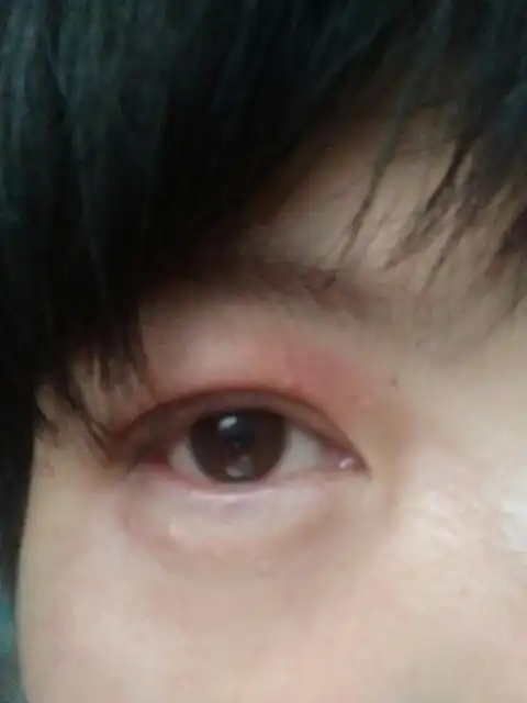 眼部扁平疣图片