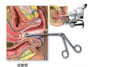 活检报告出来了,hpv阳性真的不用怕,不放弃就会好