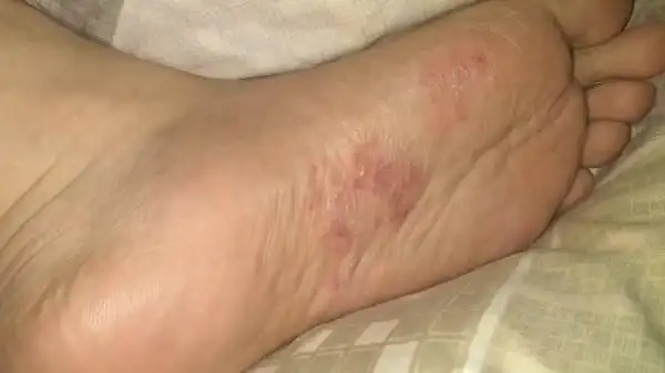 左脚脚底痒,脱皮是怎么回事?附上图片