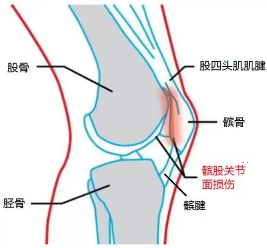健康跑步后膝盖疼痛警惕跑步膝