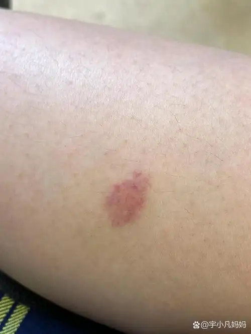 天呐 我被蟑螂咬了?