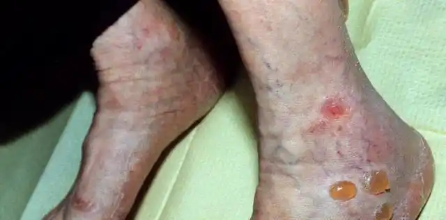 身体出现这4个皮肤表现你可能患上糖尿病了早发现早预防