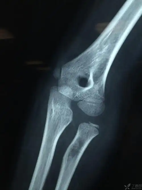 桡骨小头脱位,请求治疗方案 - 骨科 - 专业医生社区,医学,药学,生命