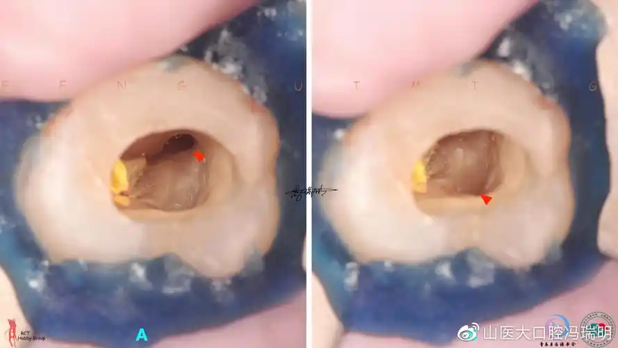 上颌第二磨牙根管解剖形态特点及病例分享