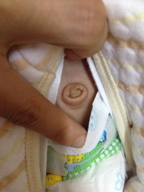 宝宝的肚脐凸出