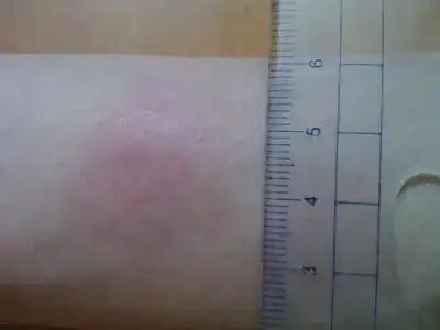 怀疑肺结核痰检却没找到结核杆菌这四个检查能帮您诊断