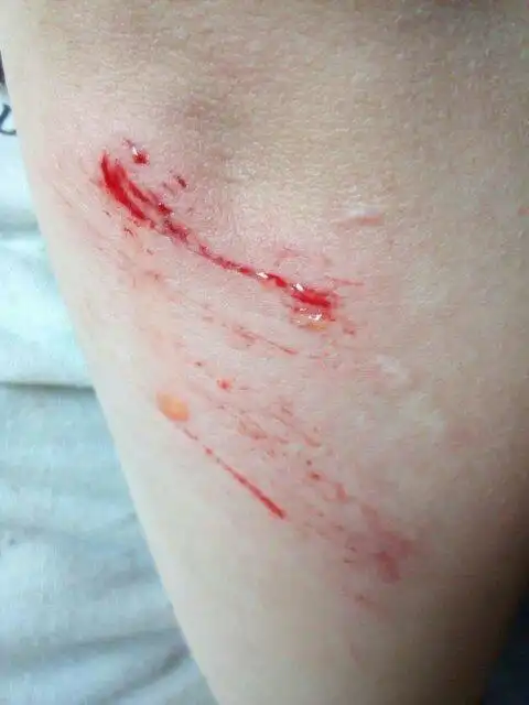 跌倒时,不小心把手臂给擦伤了,应该用什么样的处理方法.