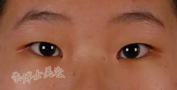 对上睑型重度内眦赘皮采用李氏改良"z"字法.