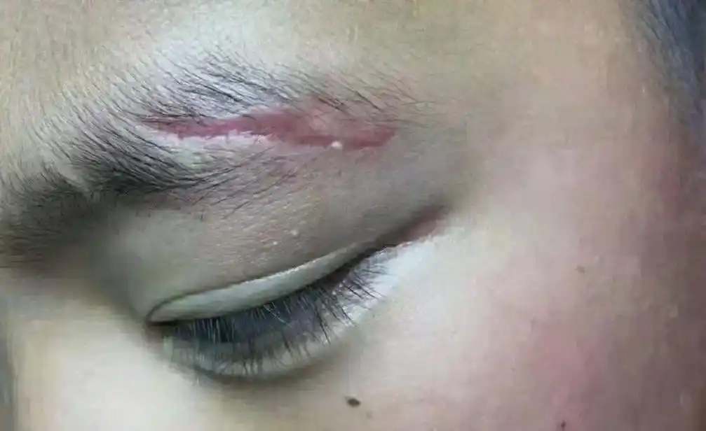 知识普及: 凹陷疤痕属于组织缺失,与增生不一样,在面部的不同 - 抖音