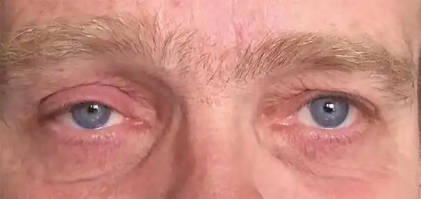 神经科临床思维养成:部分性 horner 综合征病因解析