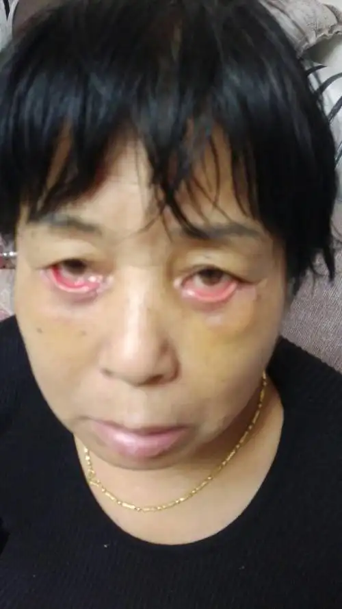 眼袋做坏了哪里可以修复?