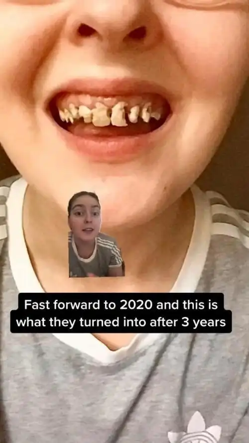 美国女子孕期常喝可乐牙齿腐烂脱落,现只剩3颗,只能装假牙