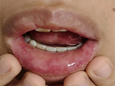 疱疹性口炎唇内侧白色水疱图-有来医生