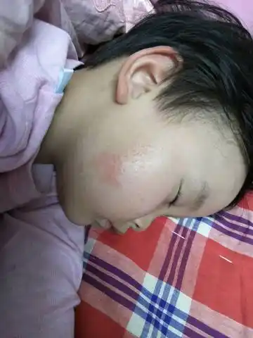 最近几天宝宝脸上起的一小片 有几处 不知道是癣还是什麼 请大家帮