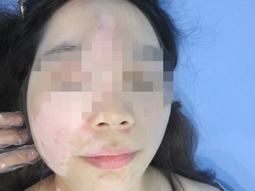 贴面膜对面部白癜风会不会有影响?__凤凰网